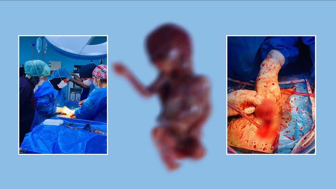 ژیانى ژنێكى دووگیان له‌ مه‌ترسی رزگار كرا كه‌ منداڵدانێكی دوو پارچه‌ى هه‌بوو