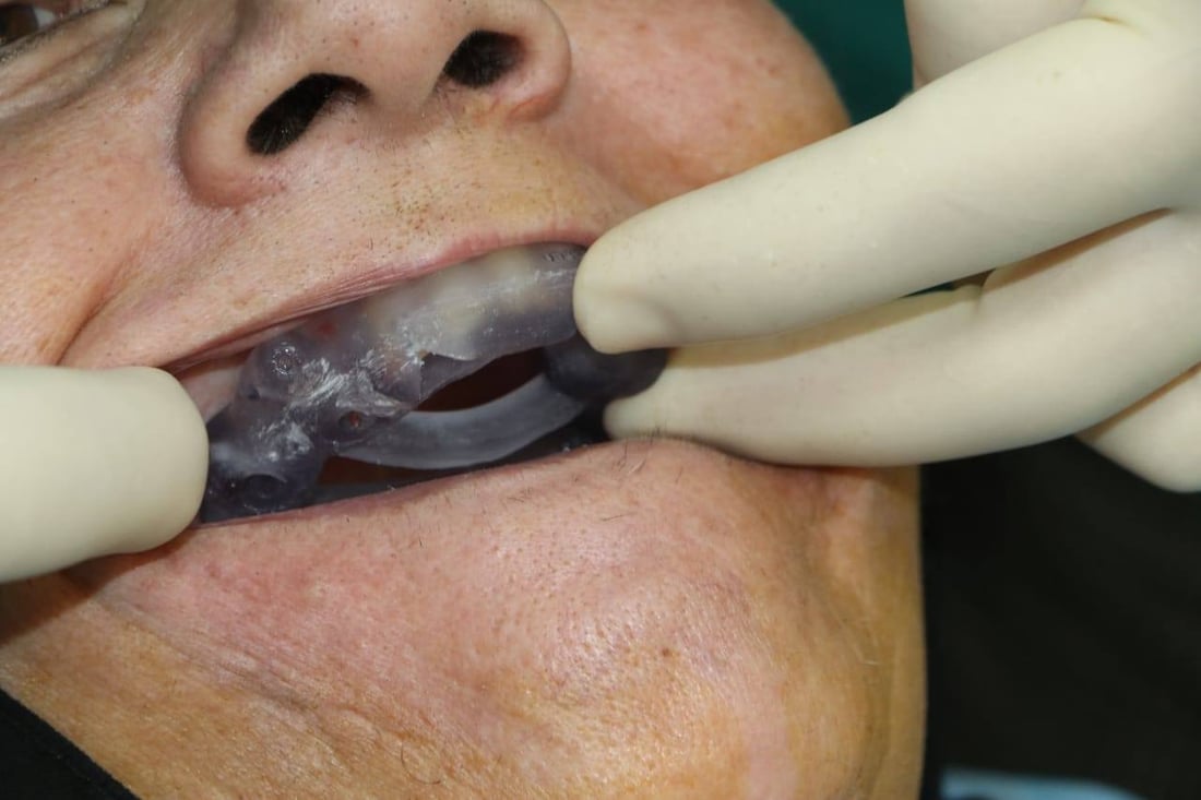 بۆ یەکەمجار لە نەخۆشخانەی ئازادی دهۆک چاندنی ددان بە تەکنیکی نوێ دەستیپێکرد