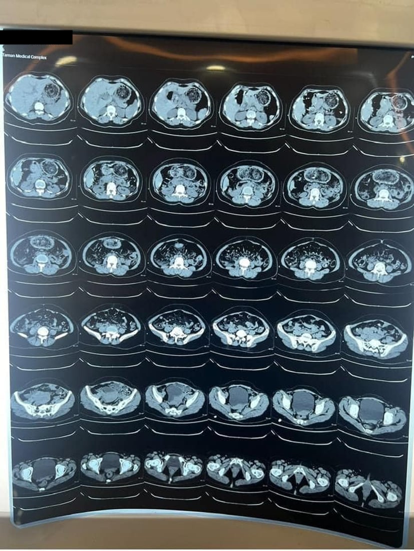 له‌ نه‌شته‌رگه‌رییه‌كى ده‌گمه‌‌ندا كچێك له‌ مردن رزگاركرا