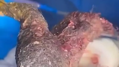 Doctors in Erbil remove nearly one kilogram of hair from woman’s stomach