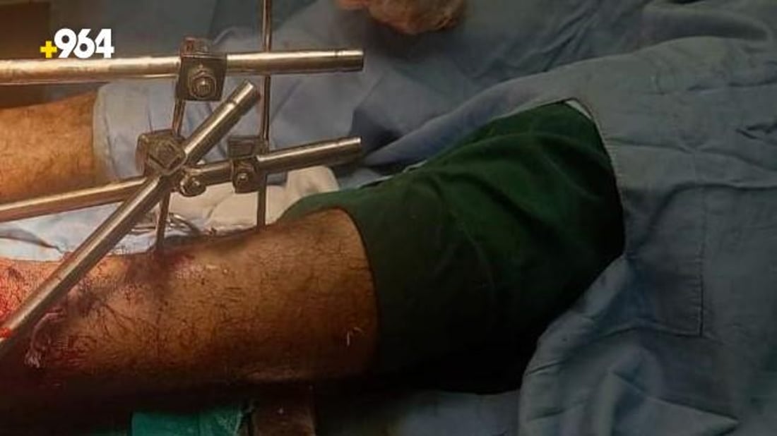 صور: أطباء ينجحون في تثبيت كسر مضاعف أسفل الساق لمصاب في تلعفر