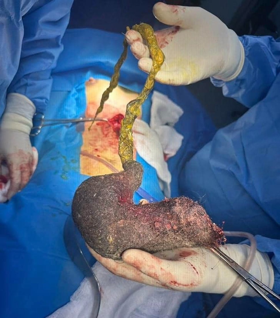 له‌ نه‌شته‌رگه‌رییه‌كى ده‌گمه‌‌ندا كچێك له‌ مردن رزگاركرا