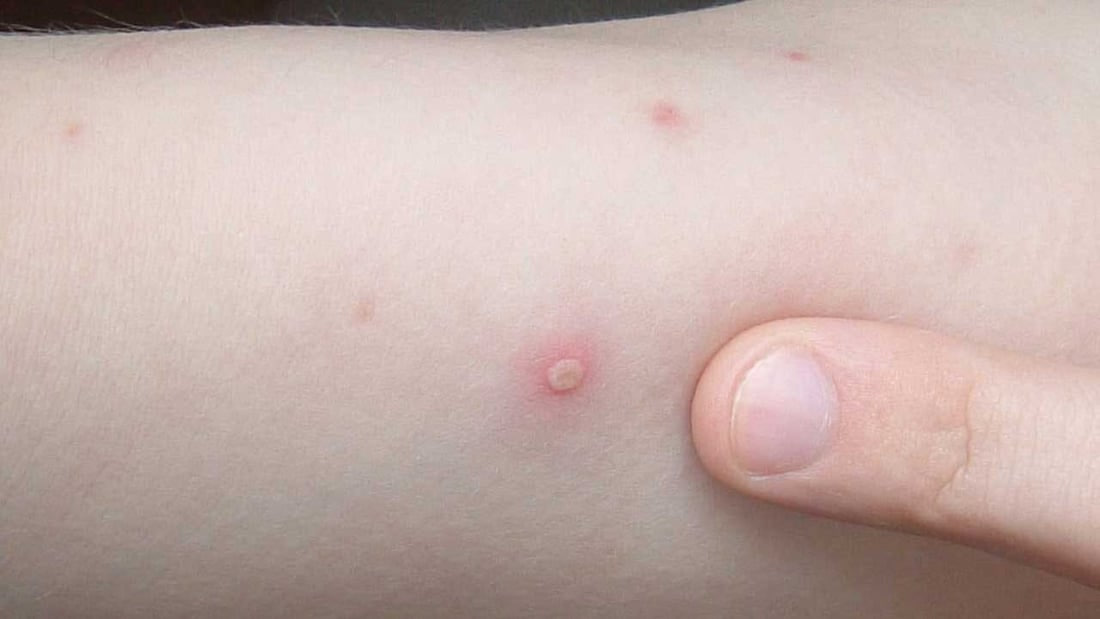 تەندروستیی هەرێم خەڵک لە ئاوڵەی مەیموون و ئەیدز ئاگادار دەکاتەوە