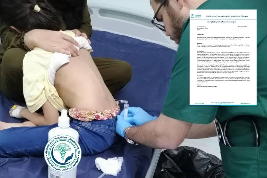 25 توشبووی هەوكردنی پەردەی مێشك لە نەخۆشخانەی كەلارن