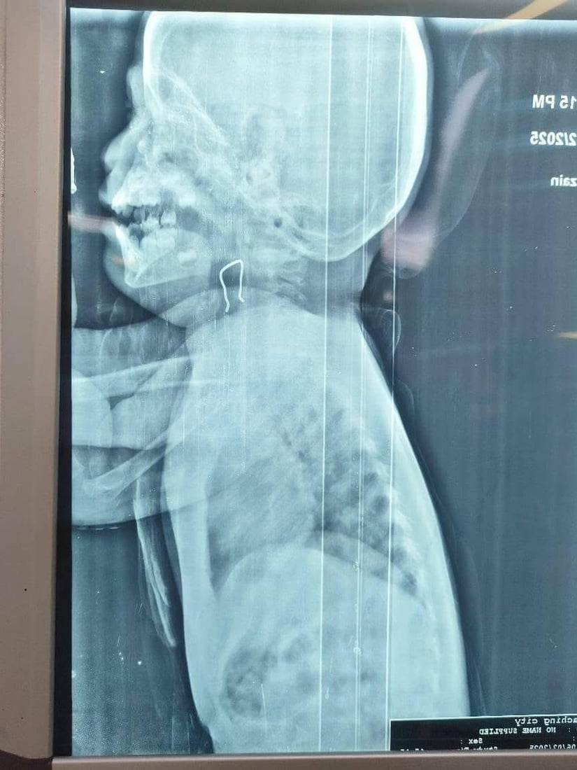 صور: طوارئ مستشفى الصدر في النجف تنقذ حياة طفل ابتلع جسماً غريباً