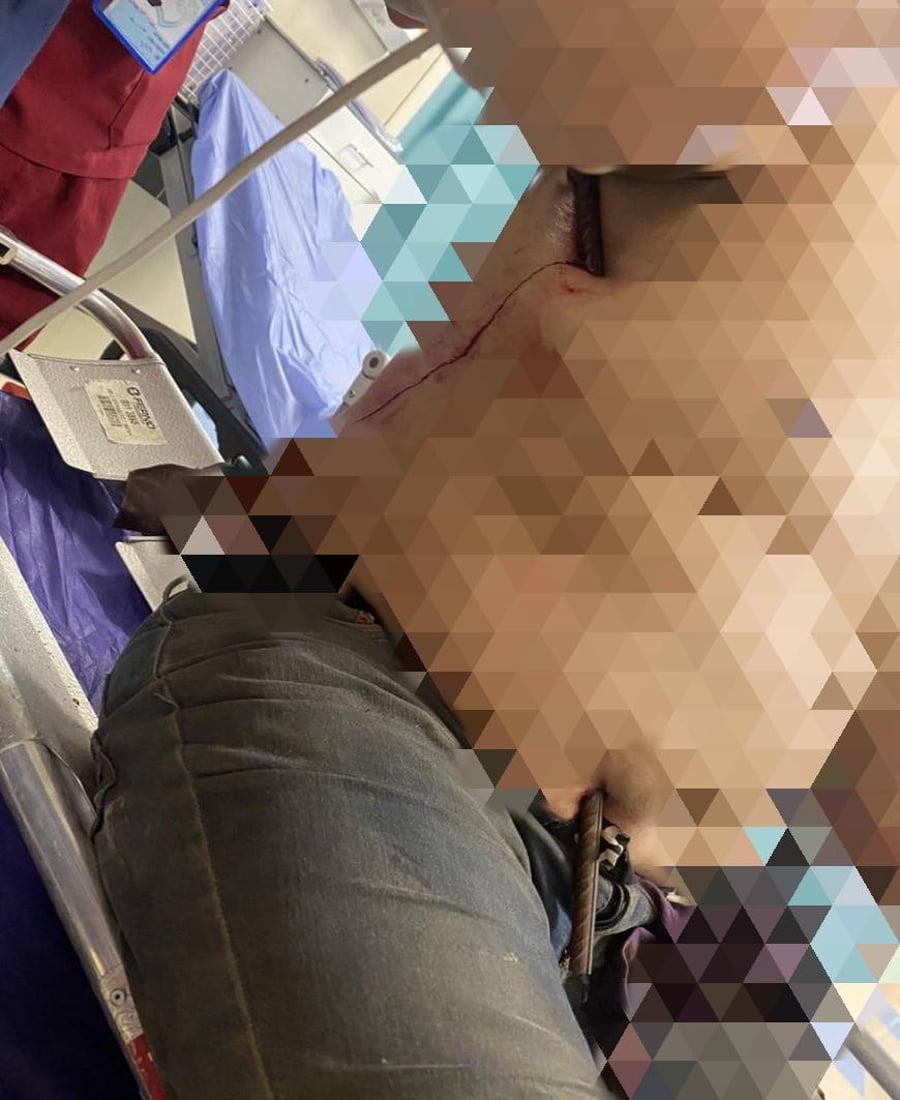 کرێکارێک شیش بە سکیداچوو و لە پشتی هاتەدەرەوە؛ ژیانی بۆ گەڕێندرایەوە