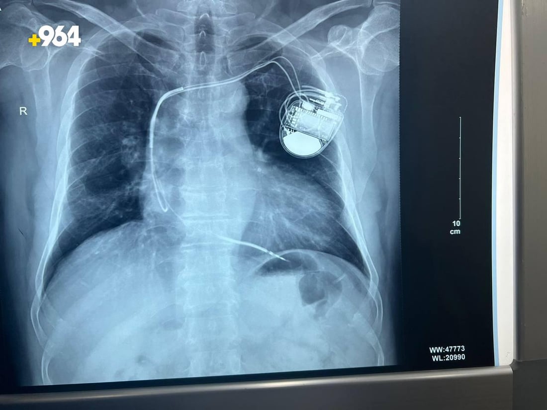 دهوك: 300 مريض يزرعون بطارية لتنظيم دقات القلب.. الضمان 10 سنوات (صور)