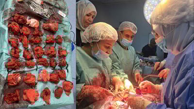 نەشتەرگەرییەکی گەورە و سەرکەوتوو؛ ژیانی دایکێکی رزگار کرد