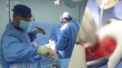 ئەمساڵ 89 نەشتەرگەری چاندنی گورچیلە لە نەخۆشخانەیەکی سلێمانی ئەنجام دراون