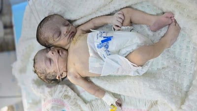 Baby with rare form of conjoined twinning born in Iraq’s Anbar governorate