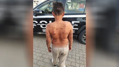 طفل يتعرض للتعذيب بماء مغلي على يد زوج أمه لعدم تحقيقه 30 ألفاً يومياً