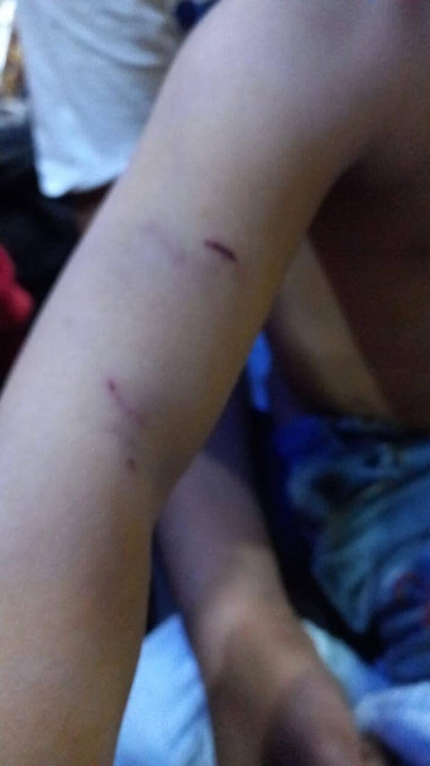 “كلاب الزعفرانية” تنهش فتاة في الـ 15 من عمرها