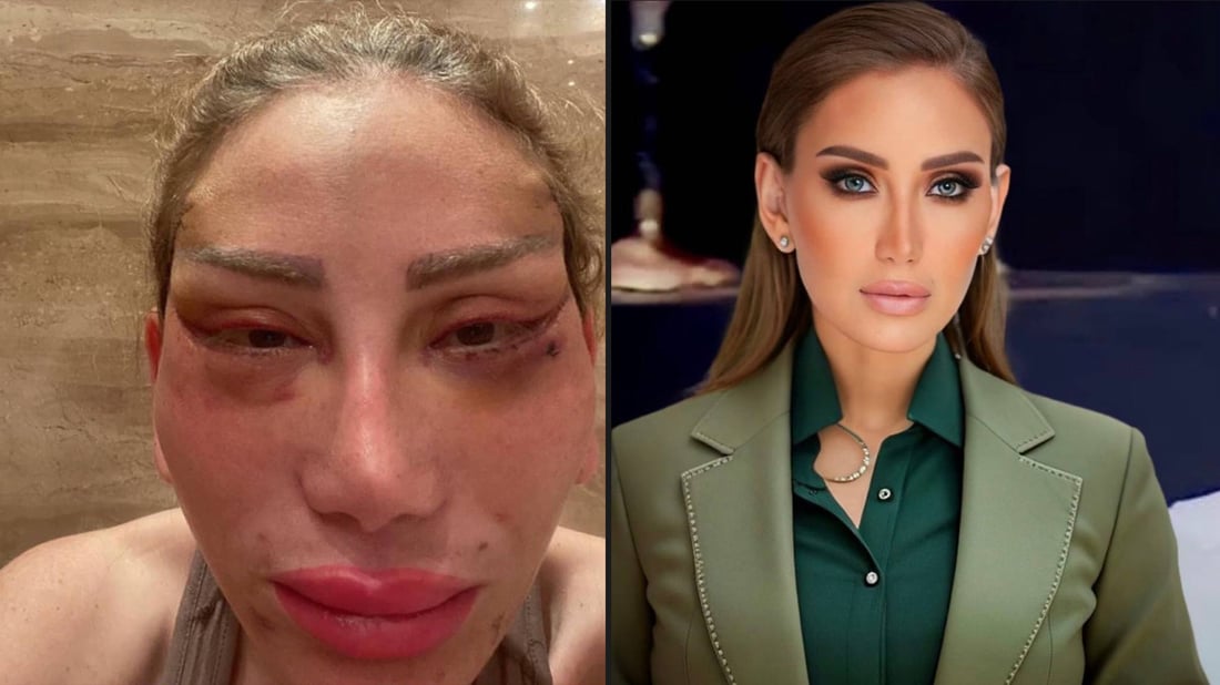 بە هۆی نەشتەرگەری جوانکاری وازی لە بەرنامەکەی هێنا