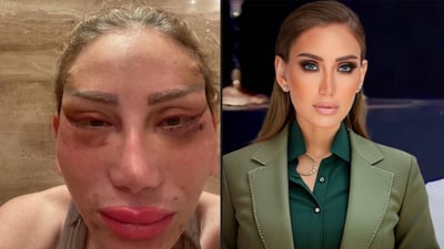 بە هۆی نەشتەرگەری جوانکاری وازی لە بەرنامەکەی هێنا