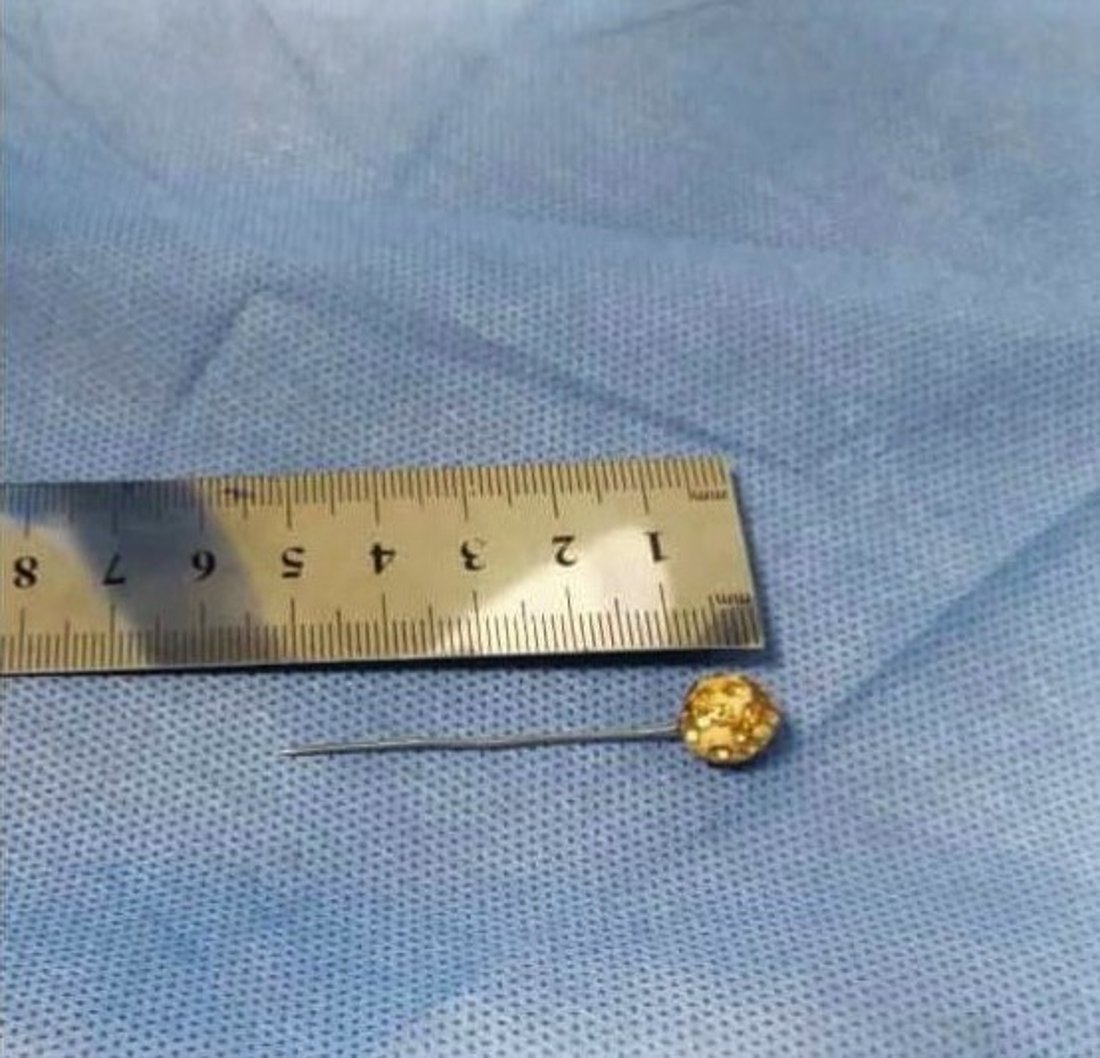 فريق موصلي ينجح باستخراج “دبوس” من جوف فتاة مضى عليه 7 أشهر (صور)