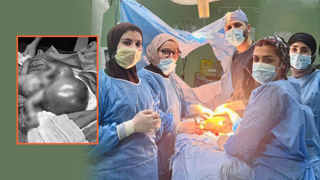 ئەمڕۆ ناوەندە تەندروستییەکانی کەرکوک رۆژەکەیان بە نەشتەرگەرییەکی دەگمەن و ئاڵۆز تێپەڕاند