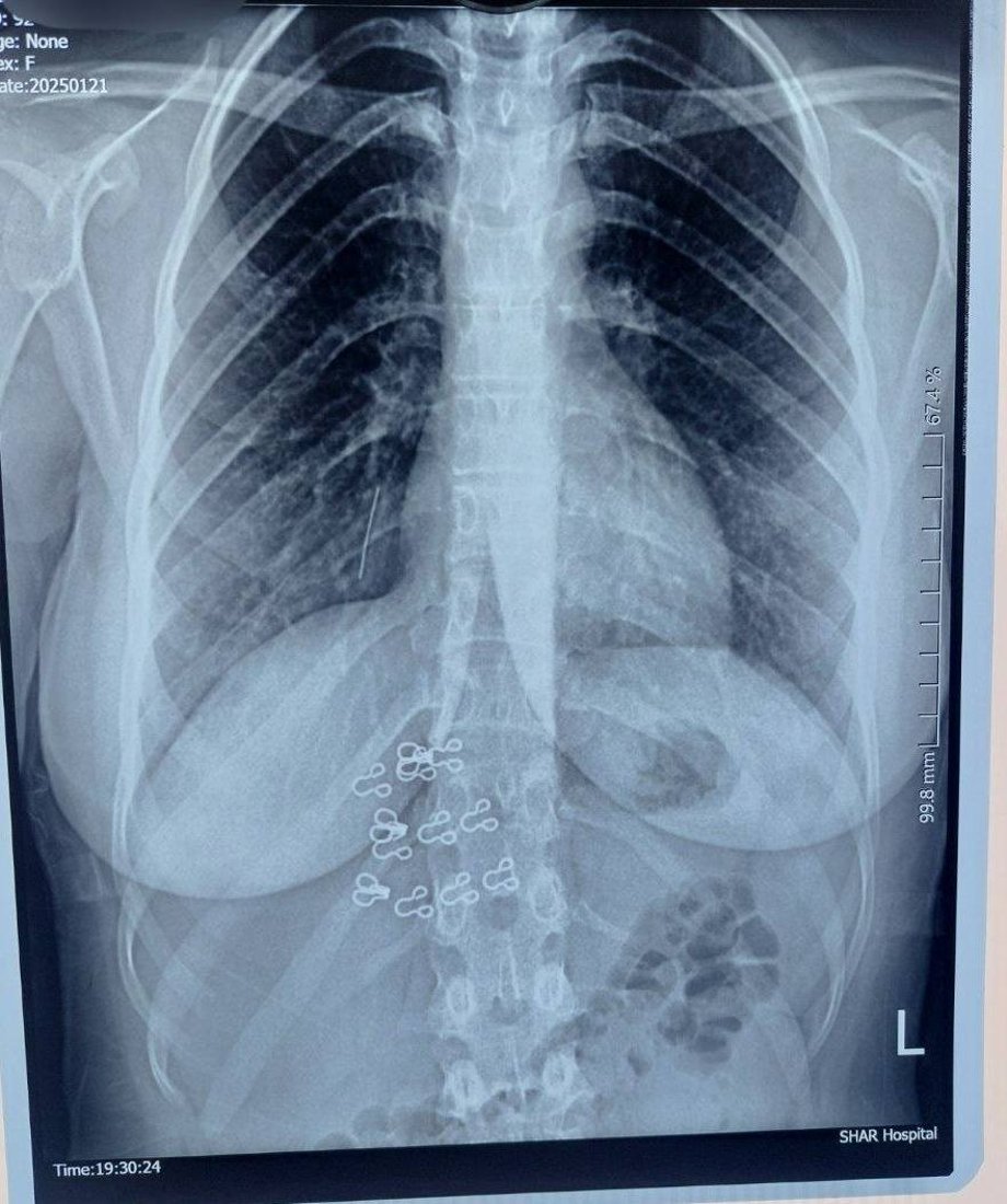 دەمبووسێک ژیانى کچێکى خستە مەترسییەوە