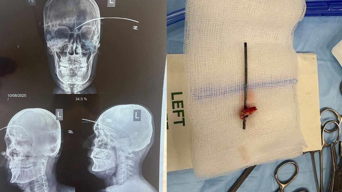 نەخۆشخانەى تکریت؛ شیشێک لە مێشکى گەنجێک دەرهێندرا