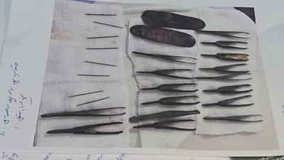 فريق طبي في السليمانية يستخرج 24 إبرة وملقط شعر من معدة شاب عشريني