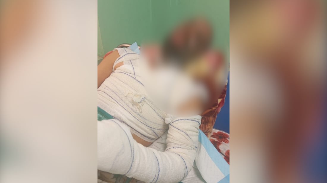 مديره السابق يؤكد وشرطة النجف تنفي.. من أحرق موظف البلدية بالتيزاب؟