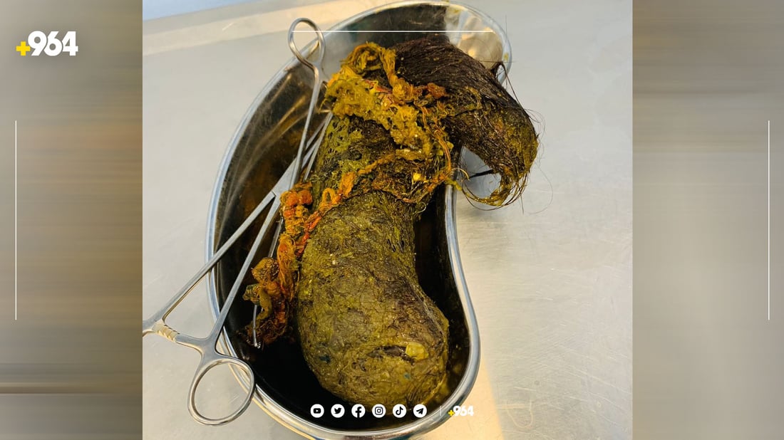 تۆپەڵێک موو لە گەدەی کچێک دەرهێندرا