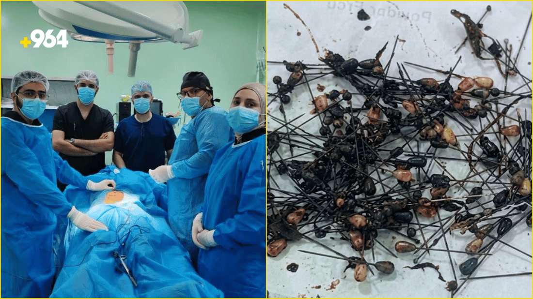 استخراج 214 دبوساً من بطن مريض.. عملية جراحية معقدة في مستشفى سامراء